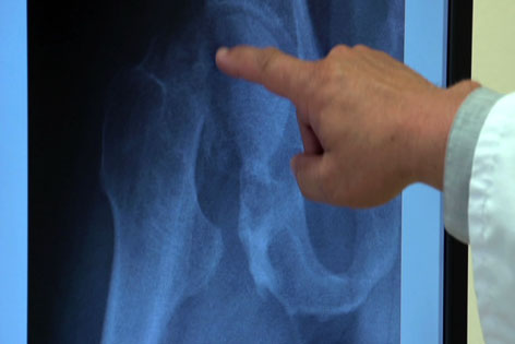 Röntgenbild bei Osteoporose