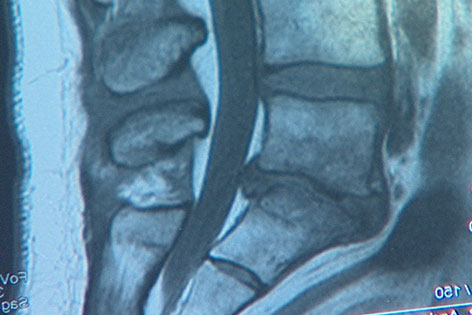 Röntgenbild eines Bandscheibenvorfalls
